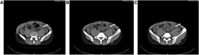 Left-sided appendicitis due to anatomical variation: A case report